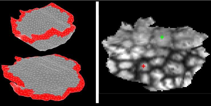 New technique stretches out MRI scans of placentas so they can be more accurately analyzed