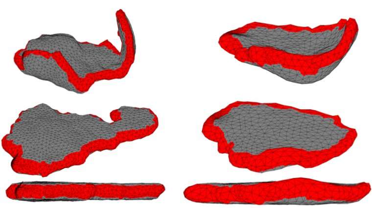 New technique stretches out MRI scans of placentas so they can be more accurately analyzed